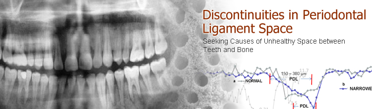 Discontinuities in Periodontal Ligament Space