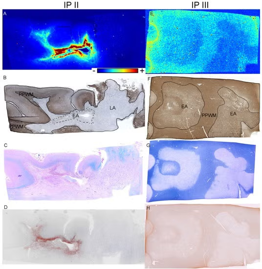 Iron in early active (EA) multiple sclerosis (MS) lesions.