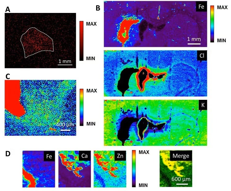 Intracerebral hemorrhage (ICH) is a subtype of stroke characterized by bleeding within the brain. Rehabilitative therapy is key to alleviating the functional deficits suffered by ICH patients. A more thorough mechanistic understanding of ICH pathophysiology and rehabilitation-induced recovery will likely lead to improvements in existing therapies and the development of novel treatments.  After the initial bleed and brain injury, ongoing processes within the peri-hematoma zone cause progressive cellular injury and dysfunction. Notably, it is widely accepted that hematoma-derived redox-active iron, which catalyzes free radical production, contributes to this secondary damage by instigating non-discriminant oxidative injury. Preclinical studies have repeatedly shown that rehabilitation (e.g., training on reaching for food starting 1 week after ICH) reduces the extent of chronic injury and improves behavioral outcome; however, the underlying mechanisms have not been fully elucidated1,2. Researchers from the University of Alberta and the University of Saskatchewan sought to clarify the effects of rehabilitation on Fe-mediated injury and other pathophysiological processes. To this end, multimodal imaging was done on brain sections from rehabilitated and untreated rats given ICH3.  Resonance Raman spectroscopy revealed that the amount of hemoglobin, the source of redox active iron, was decreased within the brains of animals given rehabilitation (Fig. A). This suggests that the therapy promotes removal of neurotoxic blood products. X-ray fluorescence imaging (XFI) at SSRL Beam Line 10-2 showed that iron concentration was increased (~ 3-fold) near the hematoma and decreased in areas further away (Fig. B). Moreover, XFI confirmed that, concomitant with the decreased amount of hemoglobin, the amount of iron in peri-hematoma tissue was diminished by rehabilitation. Also, β-sheet protein aggregate content, a measure of oxidation, was determined using Fourier transform infrared imaging (Fig. C). Aggregate content was increased in tissue immediately surrounding the hematoma. These findings are consistent with the idea that iron slowly liberated from hemoglobin spreads into surrounding tissue to promote free radical production and cell damage. Importantly, rehabilitation normalized aggregate content in the peri-hematoma area. Cumulatively, these data indicate that long-term iron-mediated oxidative damage occurs after ICH and is attenuated by rehabilitation.