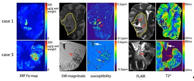Figure 1. Correlation between XRF iron maps and MR imaging (SWI magnitude images (TE=18.5ms), susceptibility maps (TE=8.2ms), FLAIR and T2* maps) for cases 1 (hemorrhagic stroke) and 3 (ischemia. The white arrows indicate possible calcification. Iron in XRF maps co-localizes with higher susceptibility in susceptibility maps (red arrows show the high iron regions). The intense spots in the susceptibility map are artifacts caused by air bubbles (yellow arrows). Ischemic lesions are outlined in FLAIR images an